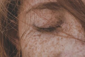 Kako stres utiče na kožu?